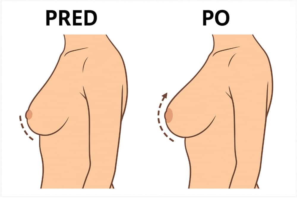 Prírodné prípravky na zväčšenie a spevnenie pŕs pred a po použití
